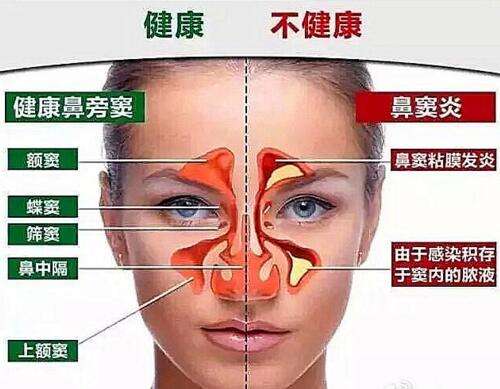 新时代鼻炎疗法突破，高效治疗迈向新时代