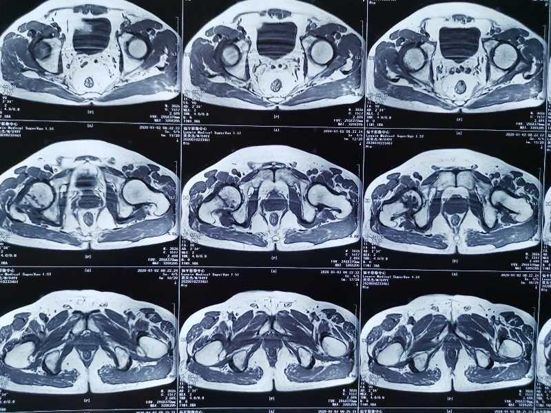 骨颈骨折最新研究，治疗、康复与预防的综合探讨